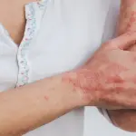 Giornata Mondiale della Psoriasi 29 Ottobre