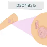 29 ottobre: giornata mondiale della psoriasi