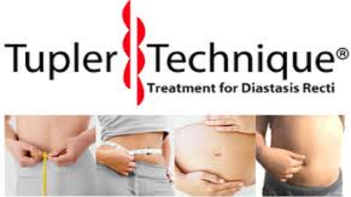 Metodo Tupler per trattare la diastasi dei retti addominali