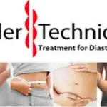 Metodo Tupler per trattare la diastasi dei retti addominali