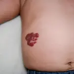 Emangioma Infantile: Una guida completa