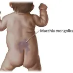 Macchie blu nei neonati: cosa sono, perché compaiono, quando spariscono