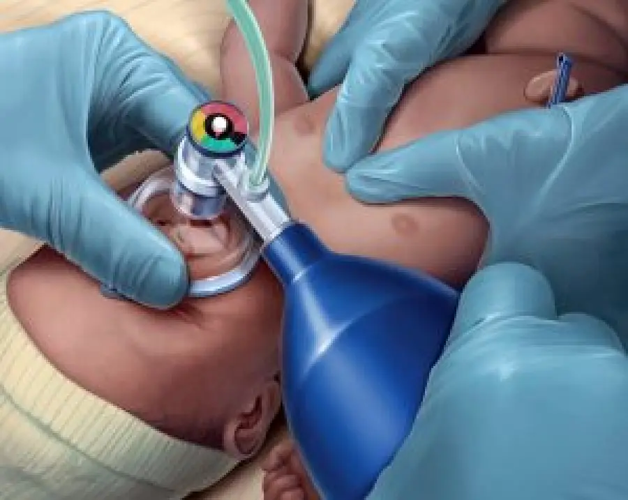 Distress respiratorio nei neonati: le cause