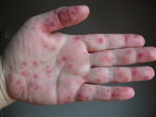 Mani bocca piedi da cosa è causata sintomi e rimedi