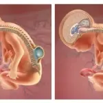 Spina bifida neonatale: è operabile in utero