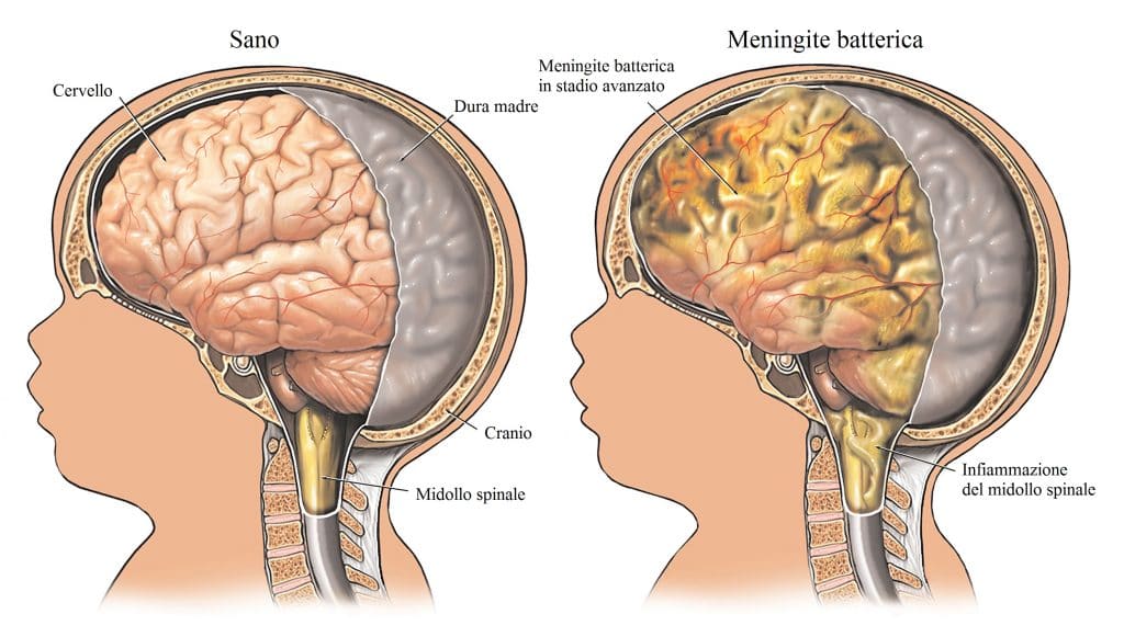 Il vaccino contro la meningite: perché è importante farlo