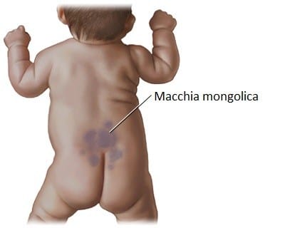 macchia mongolica 1