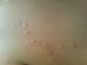allergie cutanee: orticaria